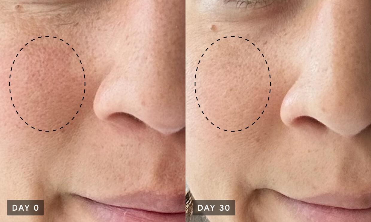 Cheek pores before and after