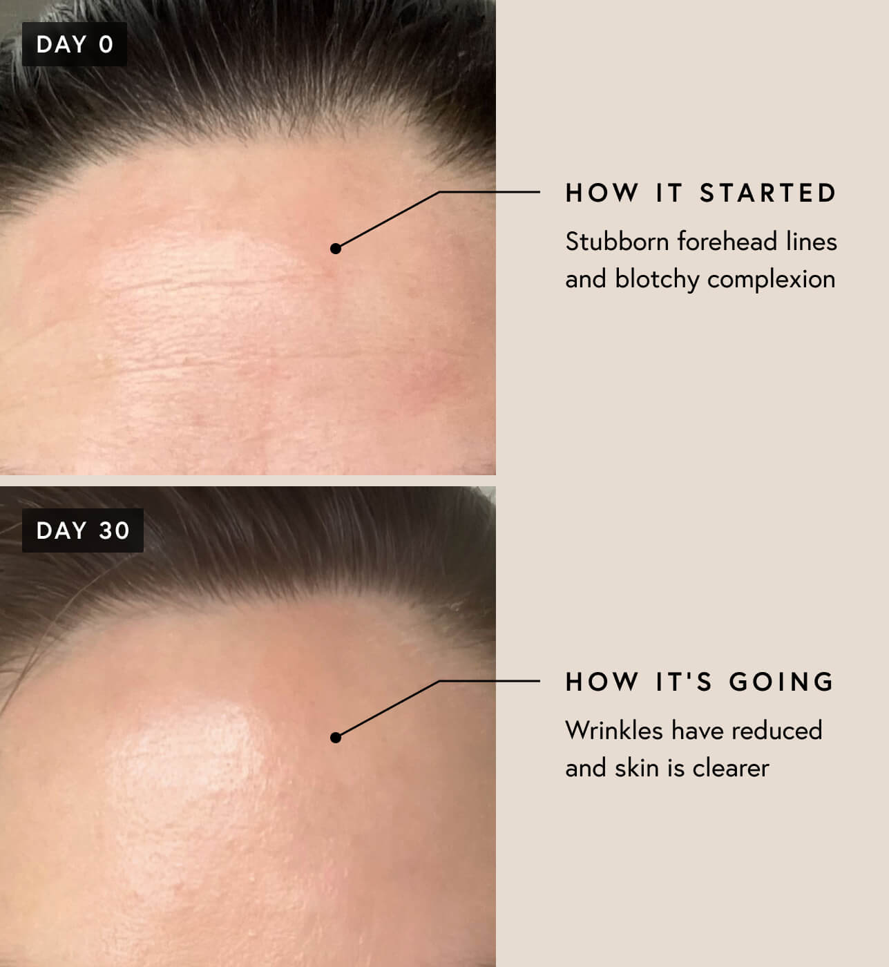 Forehead lines and blotchiness before and after