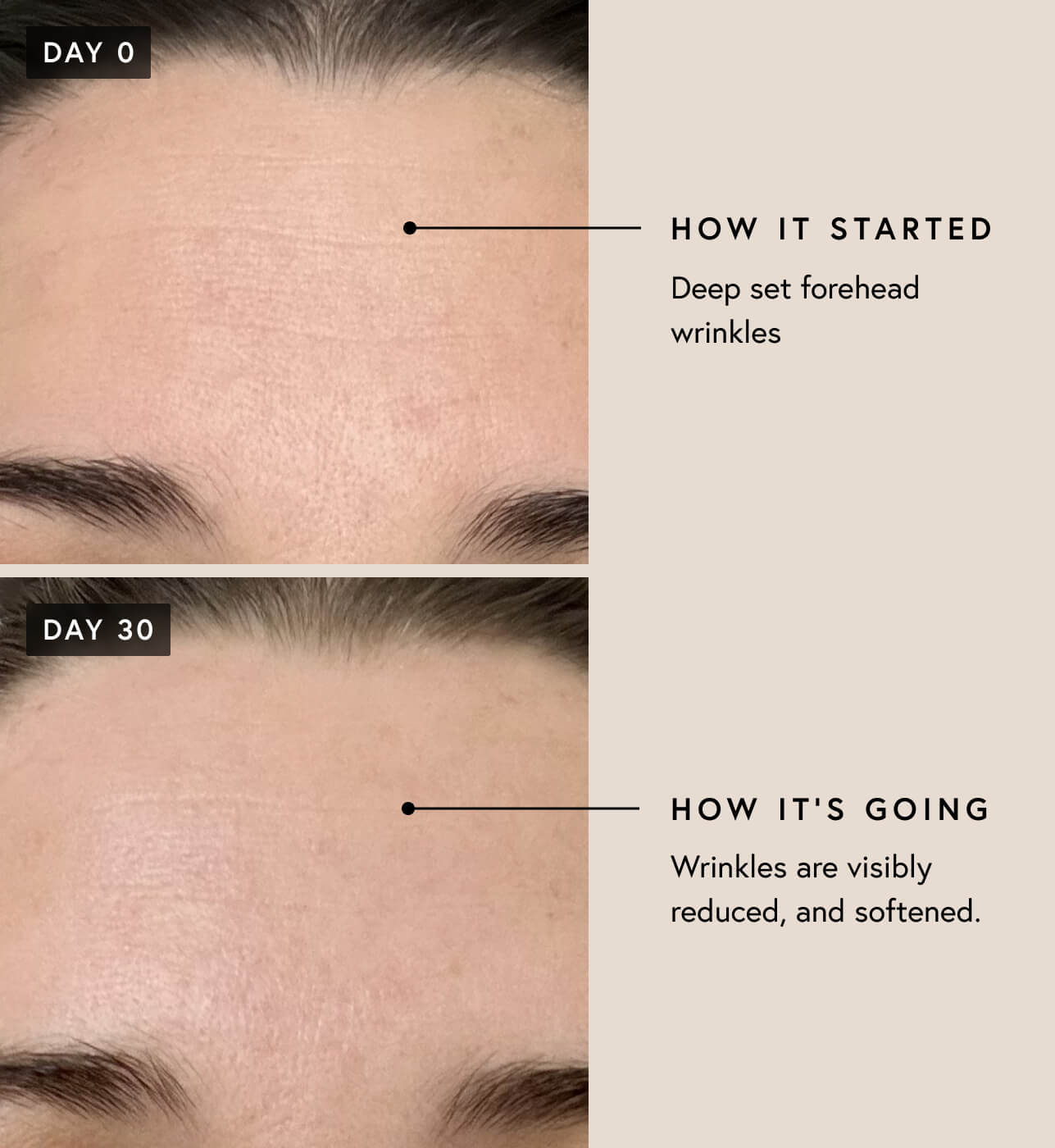 Forehead wrinkles before and after